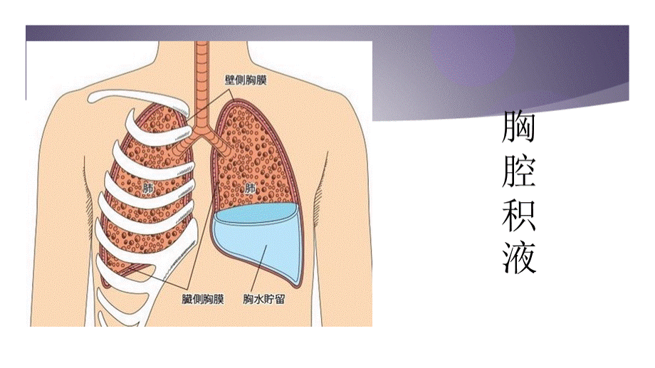 胸腔积液患者病例讨论.ppt_第2页