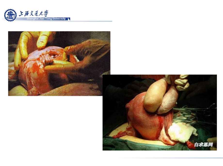 产科学英文课件：17 子宫破裂 rupture of uterus.pptx_第2页