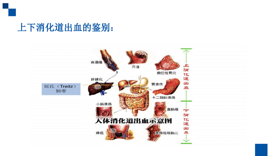 急诊急救消化道出血的护理.pptx_第3页