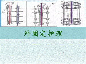 外固定护理.pptx