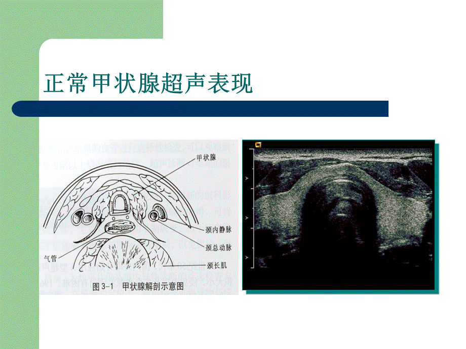 甲状腺与甲状旁腺.ppt_第3页