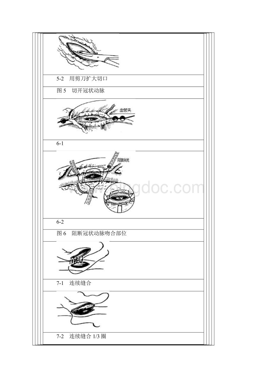 最新冠状动脉旁路移植术.docx_第3页