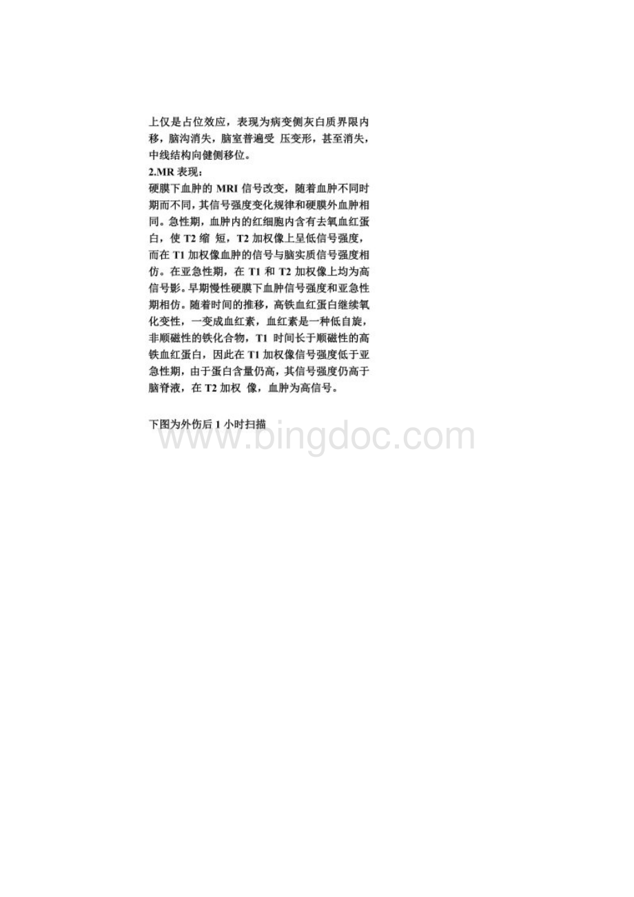 硬膜下血肿Word格式.docx_第3页