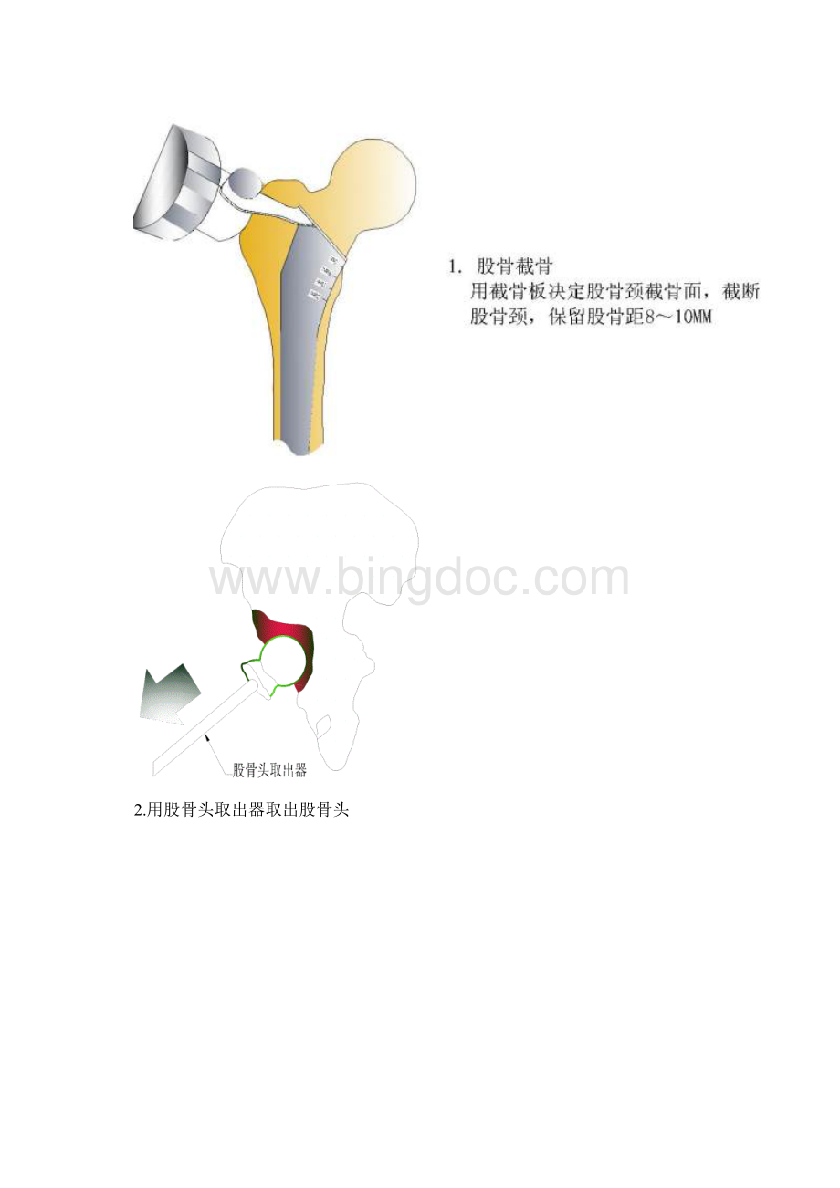 髋关节置换手术操作流程修订稿.docx_第2页