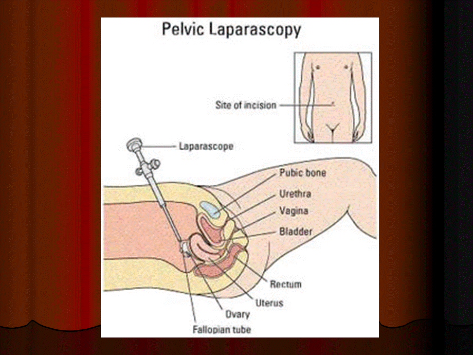 妇科腹腔镜手术的并发症.ppt_第2页