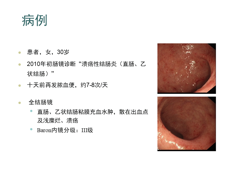 溃疡性结肠炎治疗规范.ppt_第2页