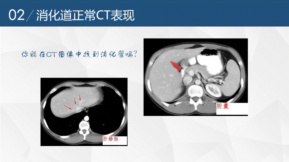 医学影像诊断基础-第四章消化系统三.pptx_第3页