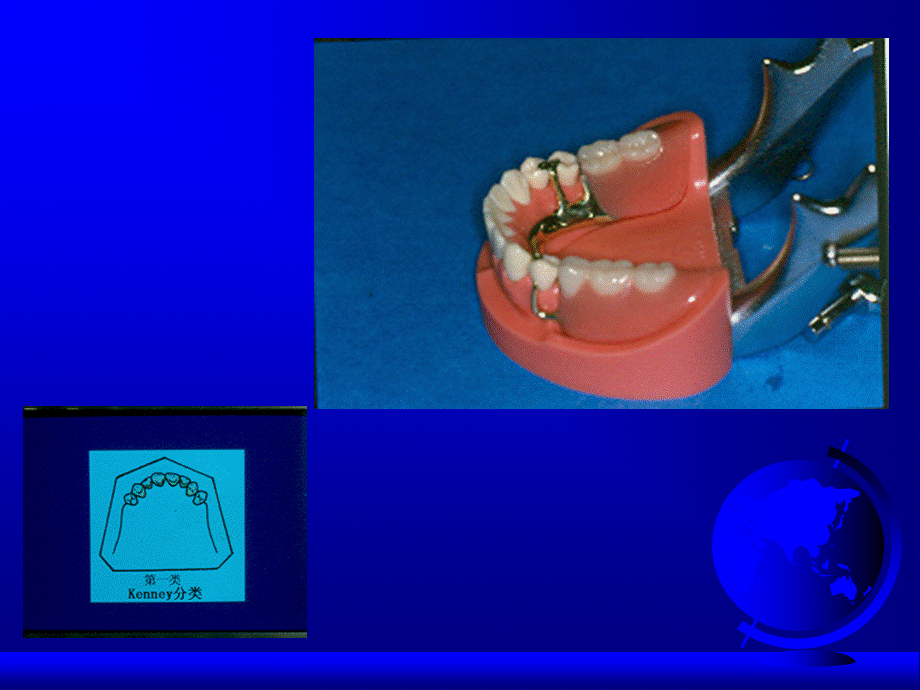 可摘局部义齿.ppt_第3页