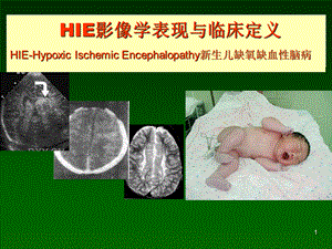新生儿缺氧缺血性脑病影像学表现与临床定义.ppt