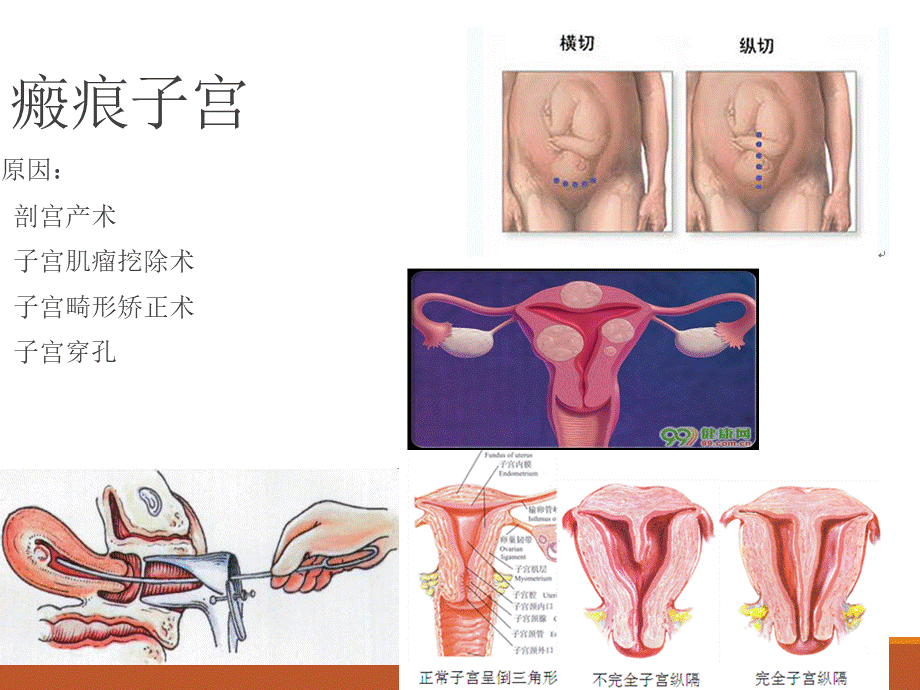 瘢痕子宫与产后出血.ppt_第3页