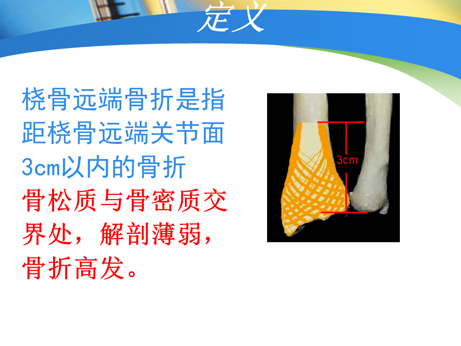 桡骨远端骨折经典教学PPT.ppt_第3页