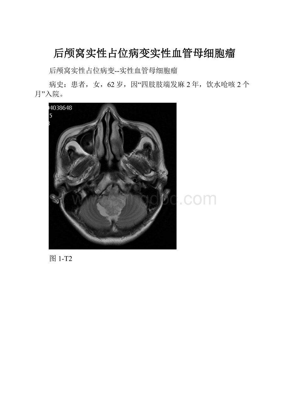 后颅窝实性占位病变实性血管母细胞瘤Word下载.docx_第1页