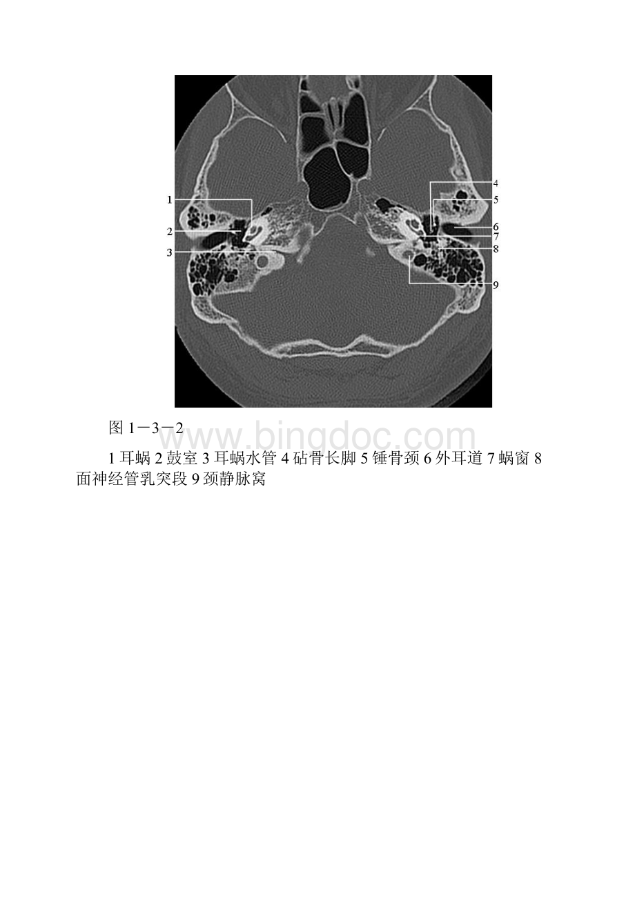 颞骨正常CT解剖附图Word文档格式.docx_第2页