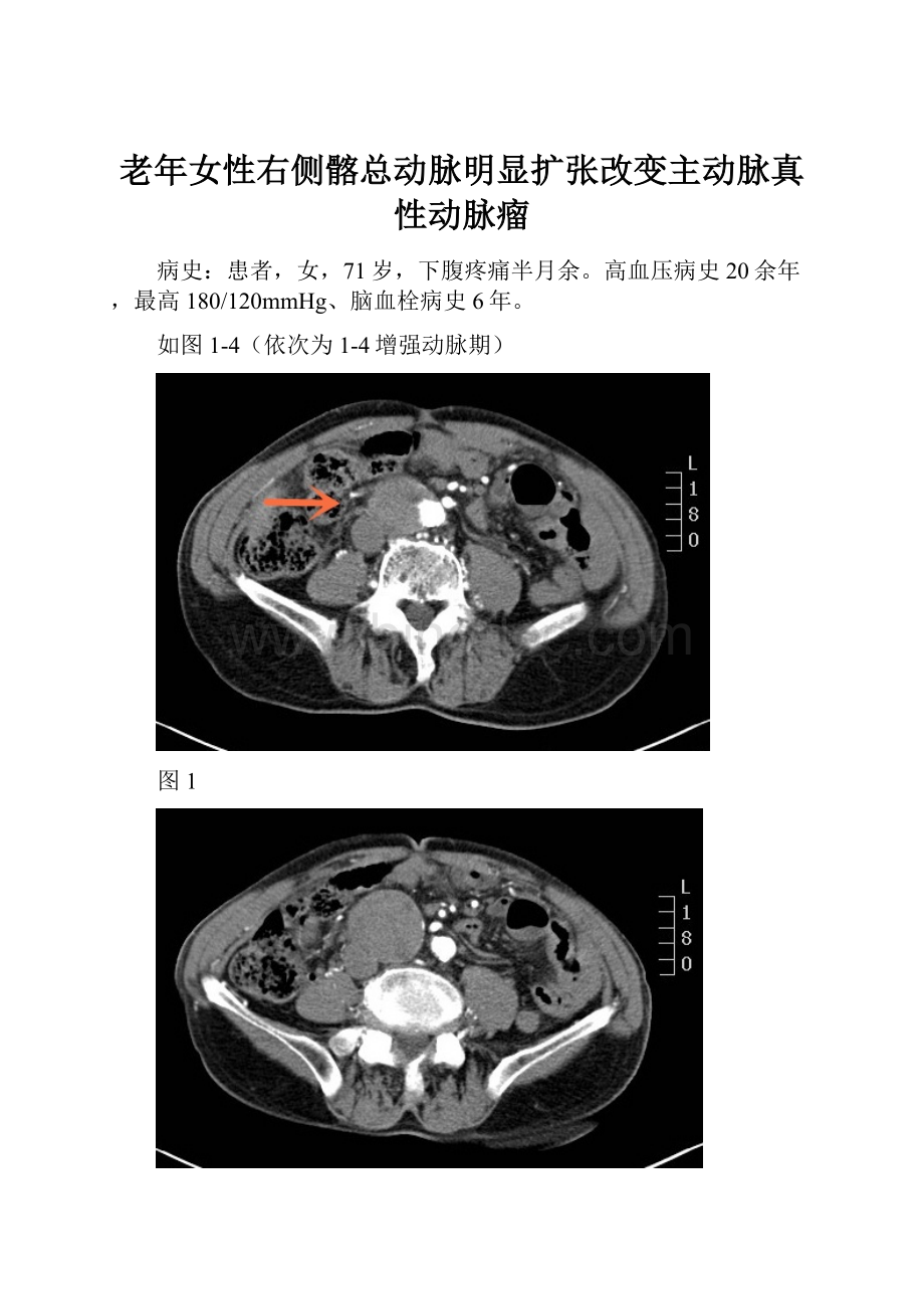老年女性右侧髂总动脉明显扩张改变主动脉真性动脉瘤.docx