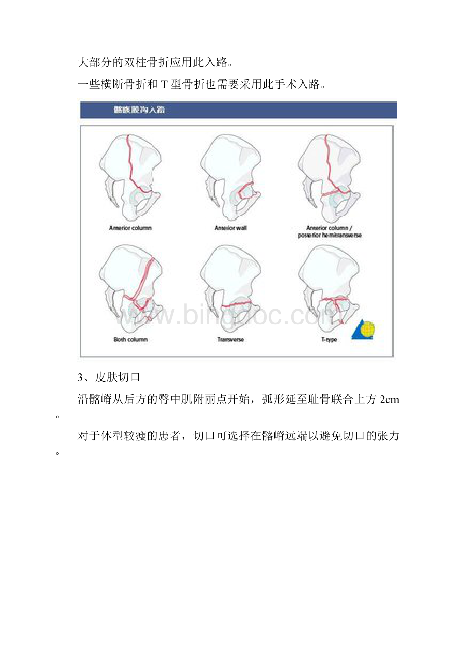 髂腹股沟入路解剖仅供参考Word格式.docx_第2页