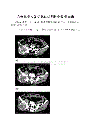 右侧髂骨多发钙化软组织肿物软骨肉瘤.docx