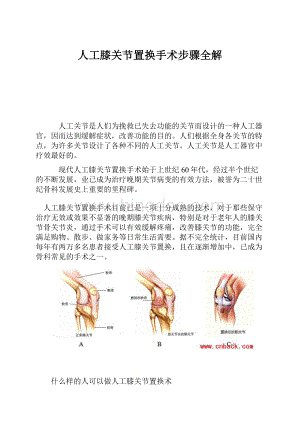 人工膝关节置换手术步骤全解.docx